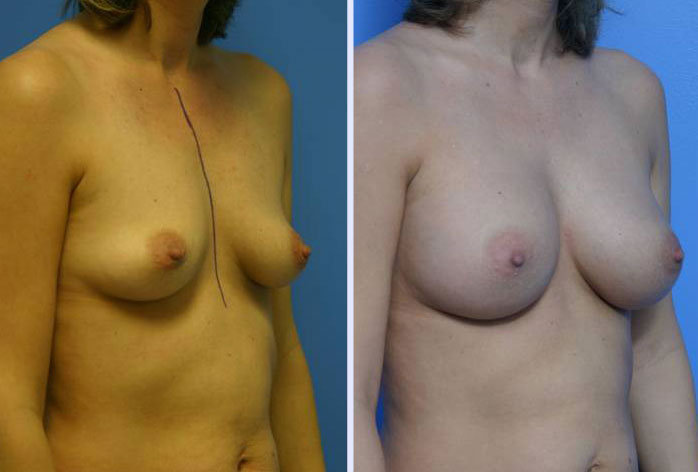 Before and After Image: breast augmentation – Case 2 - right-front-oblique