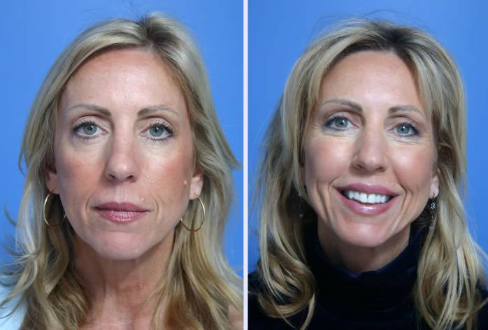 Before and After Image: facial fat grafting – case 1 - front