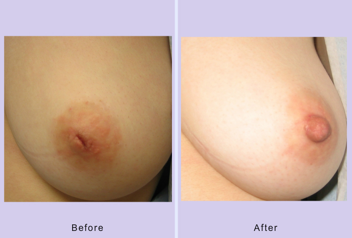 Before and After Image: inverted nipple repair – case 1 - front