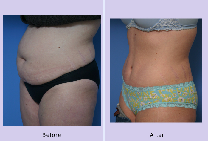 Before and After Image: abdominoplasty – tummy tuck – Case 15 - left-front-oblique