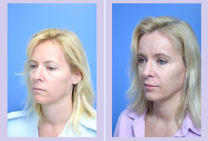 Before and After Image: facial fat grafting – case 6 - left-front-oblique