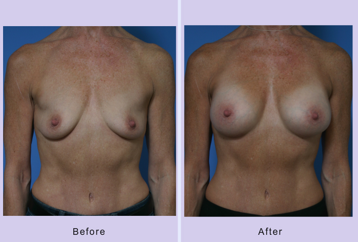 Before and After Image: breast augmentation – Case 25 - front