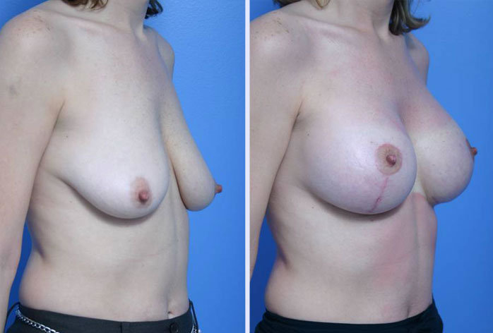 Before and After Image: breast lift – case 2 - right-front-oblique