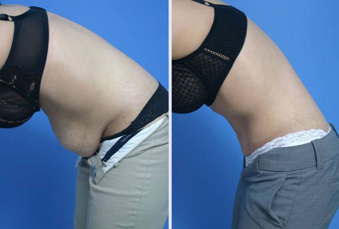Before and After Image: abdominoplasty – tummy tuck – Case 9 - left-side