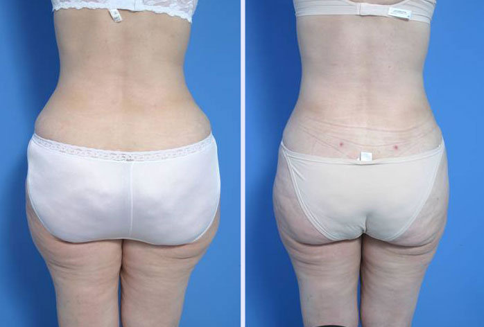 Before and After Image: liposuction – case 3 - back