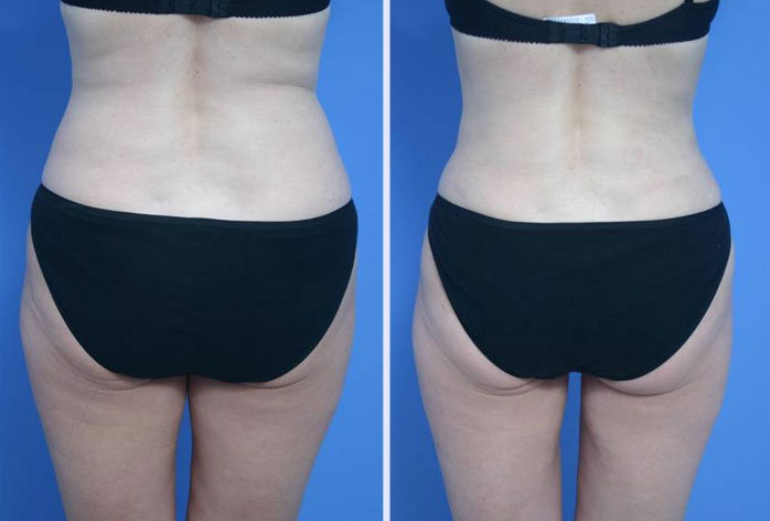 Before and After Image: liposuction – case 13 - back