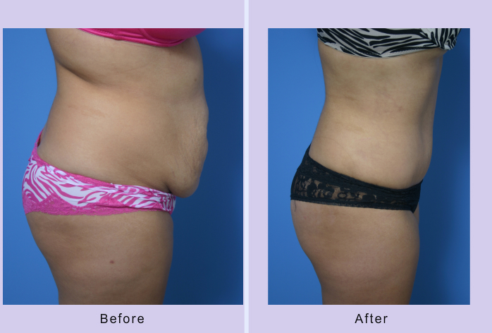 Before and After Image: abdominoplasty – tummy tuck – Case 14 - right-side