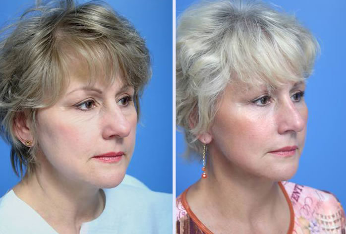 Before and After Image: 3-d volumetric facelift – case 4 - right-front-oblique