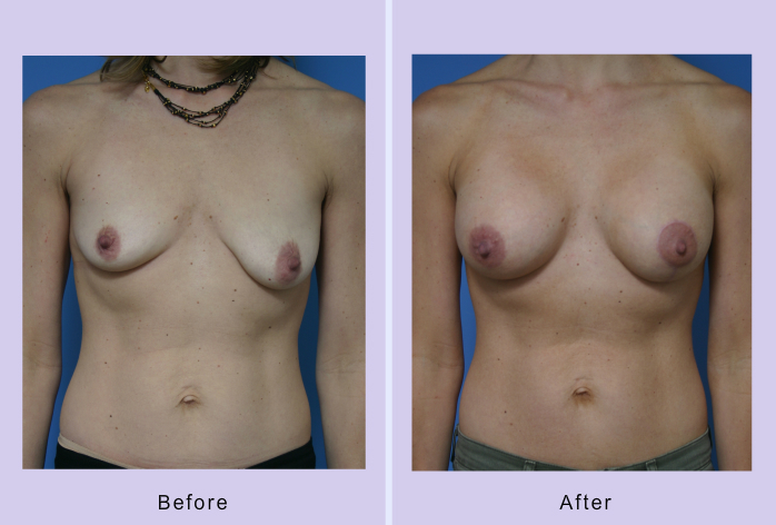 Before and After Image: breast lift – case 8 - other