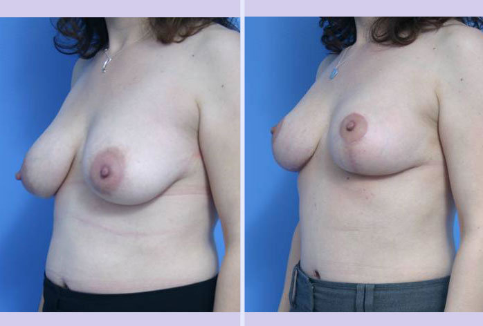 Before and After Image: breast lift – case 6 - left-front-oblique