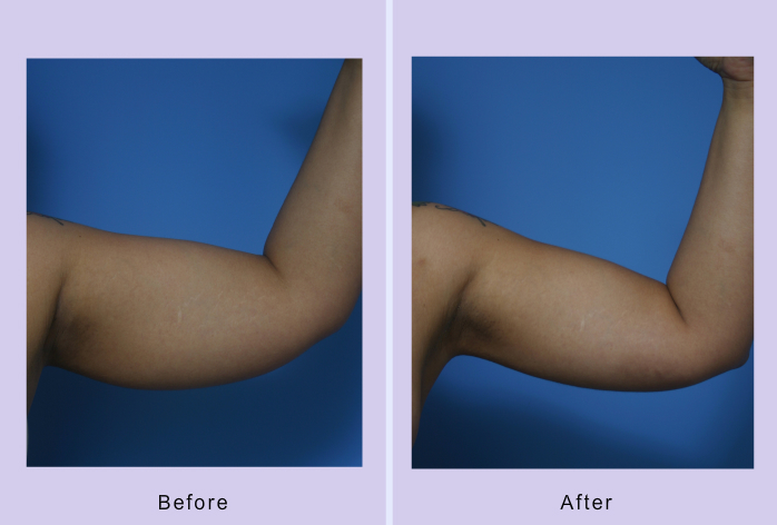 Before and After Image: liposuction – case 14 - right-side