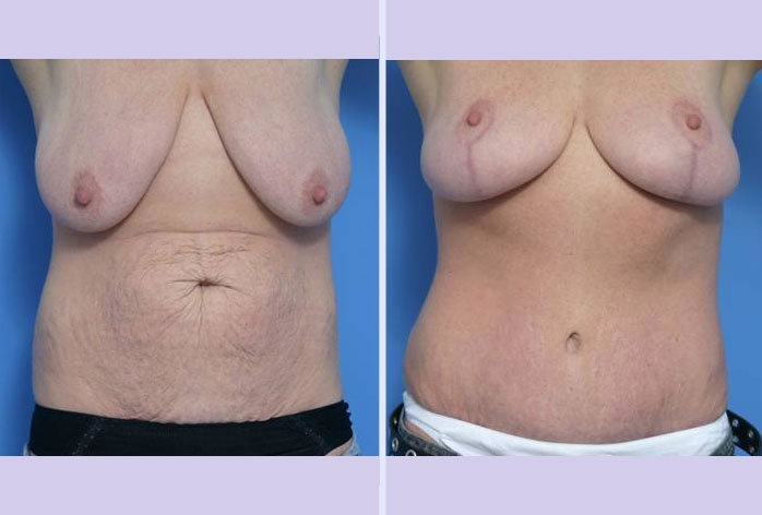 Before and After Image: mommy makeover – case 2 - front