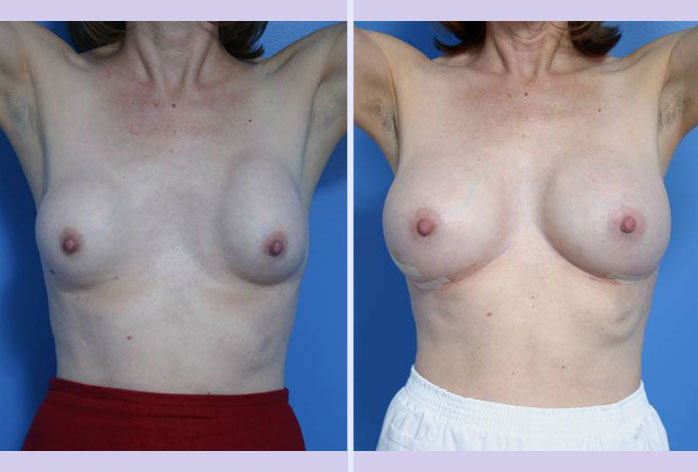 Before and After Image: breast correction – case 1 - front