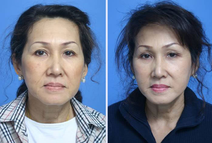 Before and After Image: facelift and mini facelift – case 10 - front