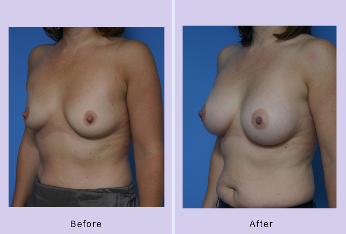 Before and After Image: breast augmentation – Case 23 - left-front-oblique
