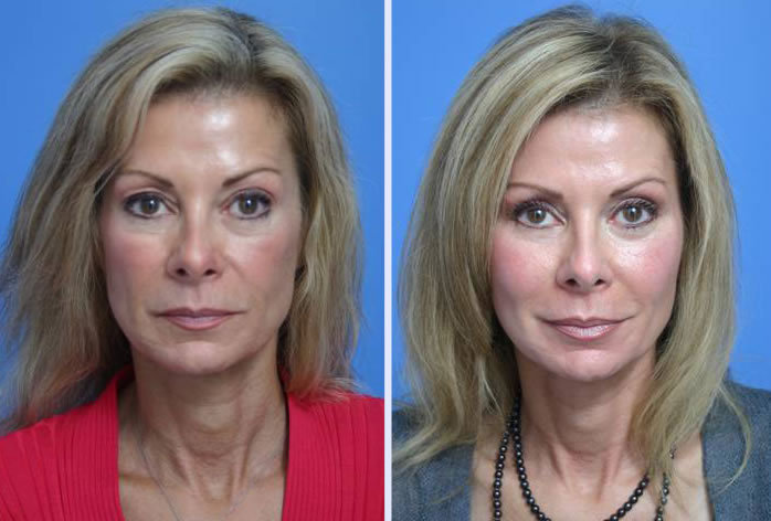 Before and After Image: facial fat grafting – case 7 - front