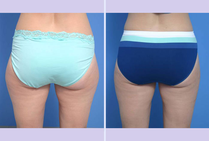Before and After Image: liposuction – case 12 - back