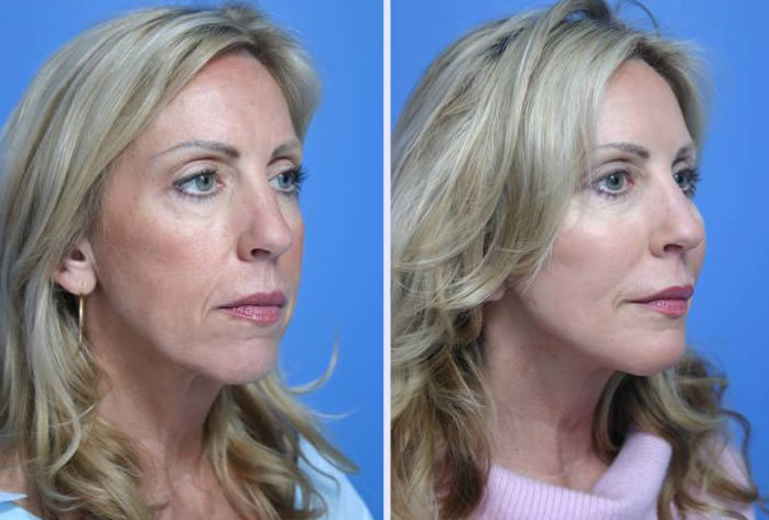 Before and After Image: 3-d volumetric facelift – case 1 - right-front-oblique