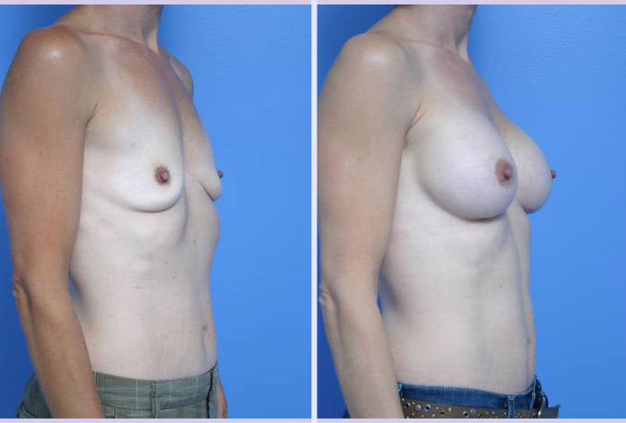 Before and After Image: breast augmentation – Case 17 - right-side