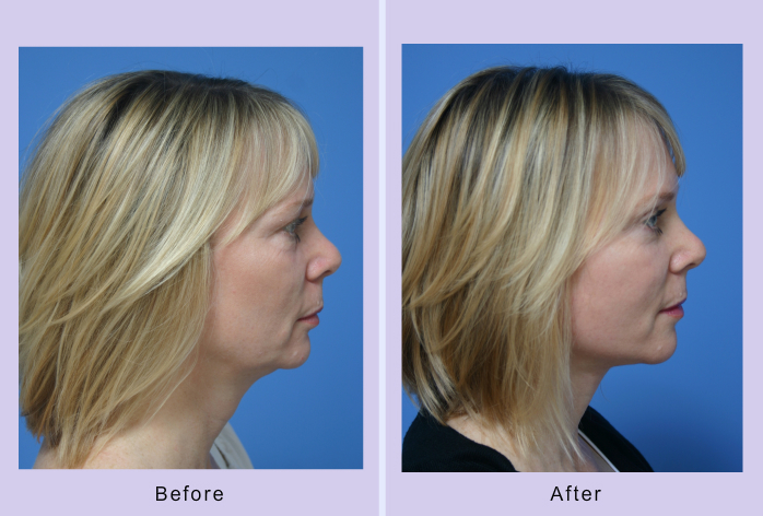 Before and After Image: facelift and mini facelift – case 4 - front