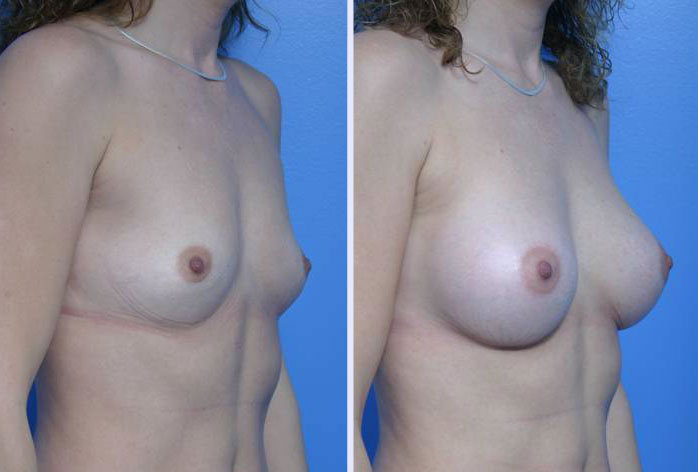 Before and After Image: breast augmentation – Case 9 - right-front-oblique