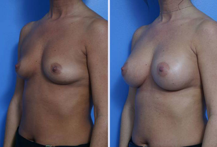 Before and After Image: breast augmentation – Case 4 - left-front-oblique