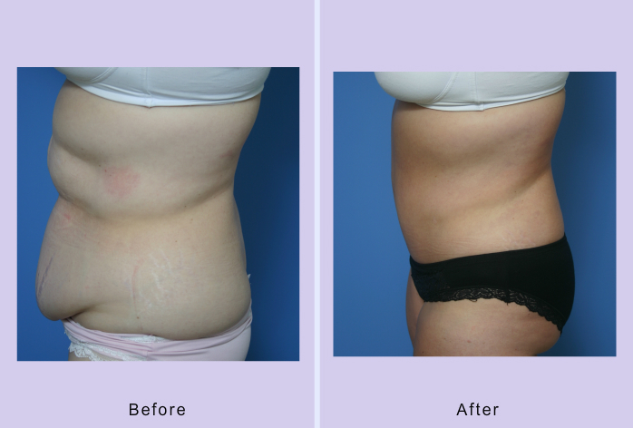 Before and After Image: abdominoplasty – tummy tuck – Case 3 - left-side
