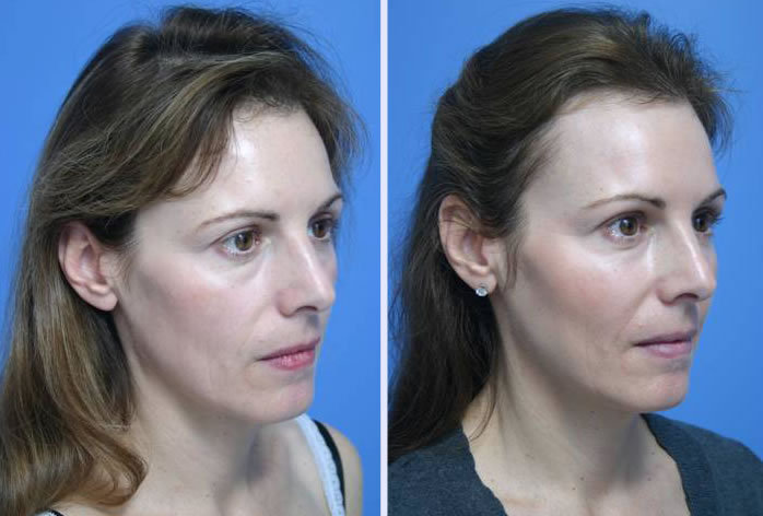 Before and After Image: facial fat grafting – case 9 - right-front-oblique