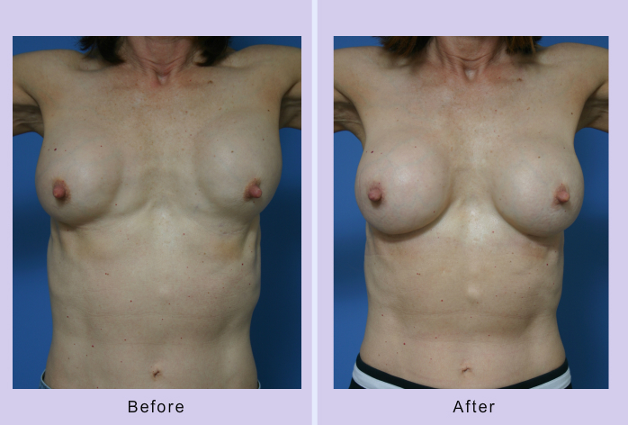 Before and After Image: breast correction – case 10 - front