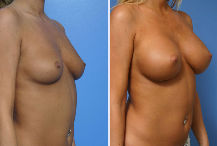 Before and After Image: breast augmentation – Case 13 - right-front-oblique