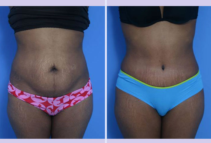 Before and After Image: abdominoplasty – tummy tuck – Case 2 - front