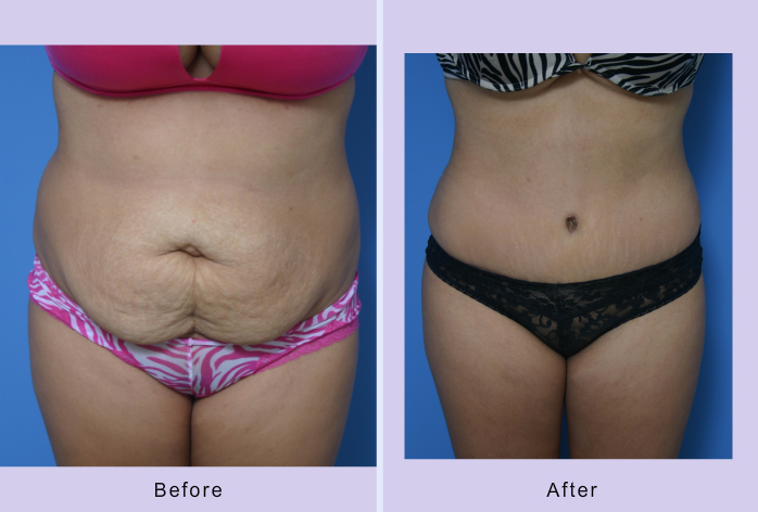 Before and After Image: abdominoplasty – tummy tuck – Case 14 - front