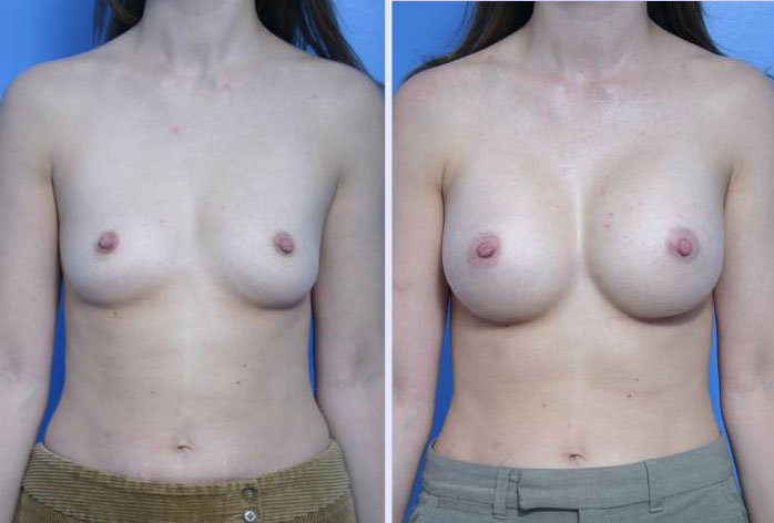 Before and After Image: breast augmentation – Case 11 - front
