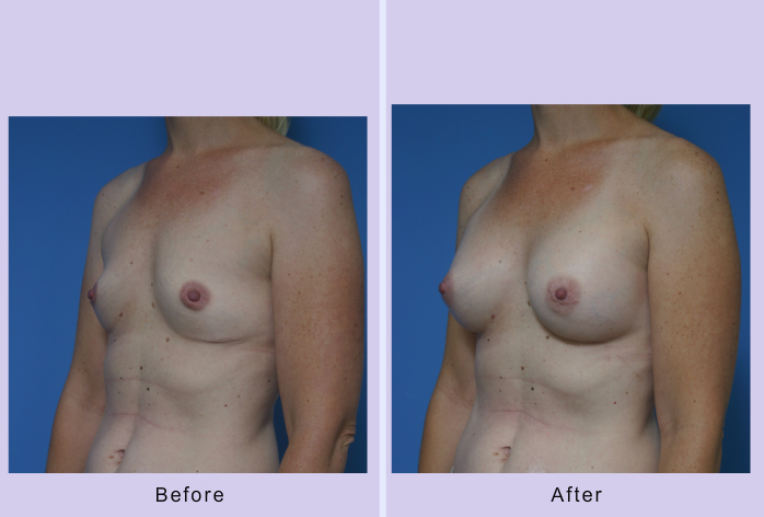 Before and After Image: breast augmentation – Case 24 - left-front-oblique