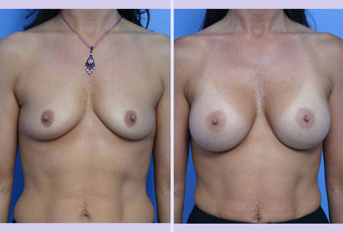 Before and After Image: breast augmentation – Case 8 - front