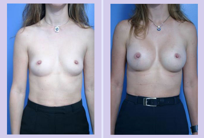 Before and After Image: breast augmentation – Case 15 - front