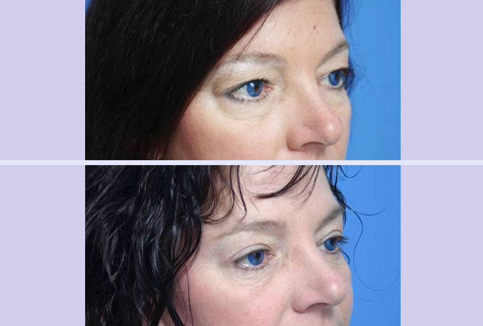 Before and After Image: blepharoplasty – case 6 - right-front-oblique