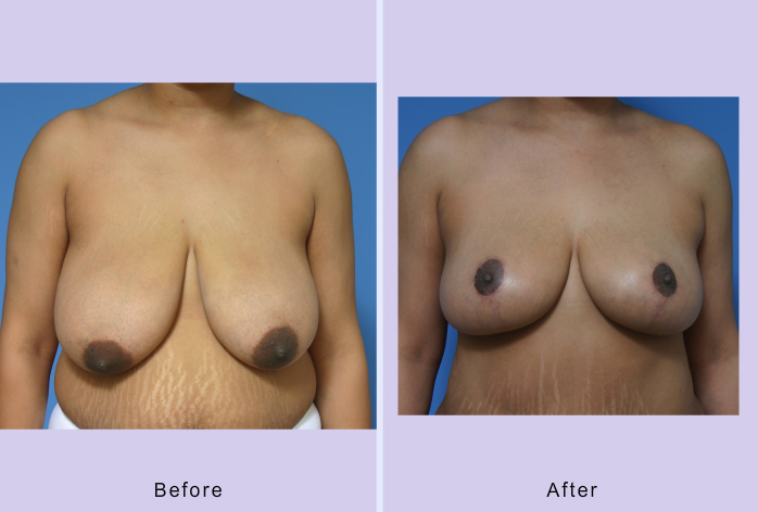 Before and After Image: breast reduction – case 5 - front