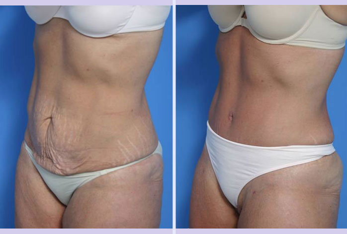 Before and After Image: abdominoplasty – tummy tuck – Case 6 - left-front-oblique