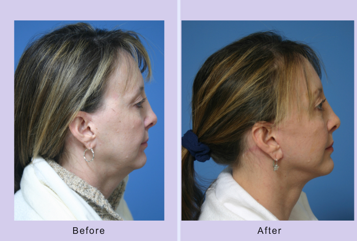Before and After Image: facelift and mini facelift – case 9 - right-side