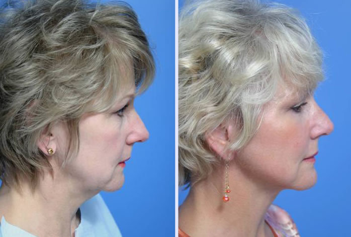 Before and After Image: 3-d volumetric facelift – case 4 - right-side
