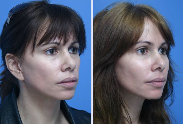 Before and After Image: facial fat grafting – case 10 - right-front-oblique