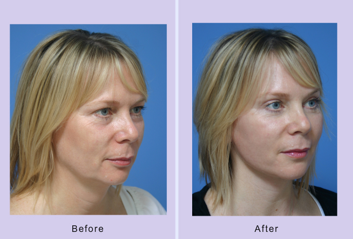 Before and After Image: facelift and mini facelift – case 4 - front