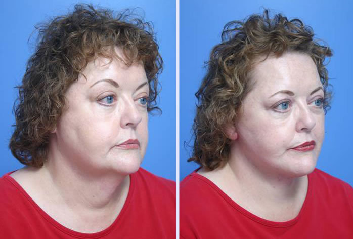 Before and After Image: facelift and mini facelift – case 8 - right-front-oblique
