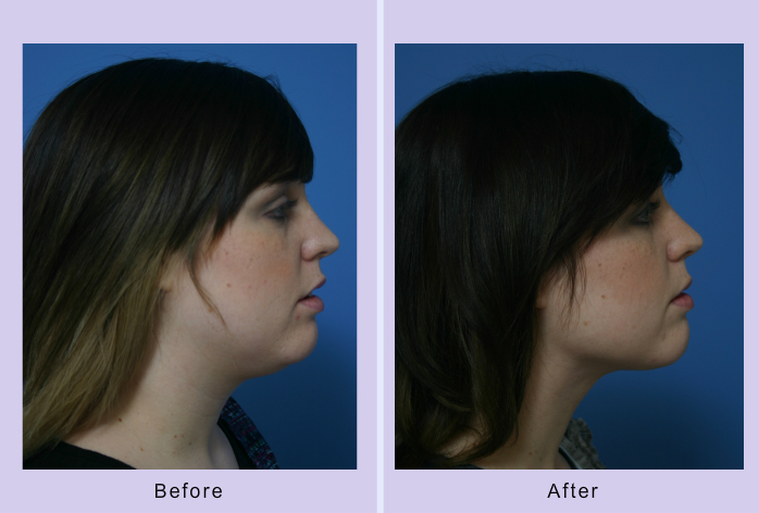 Before and After Image: submental liposuction – case 4 - right-side