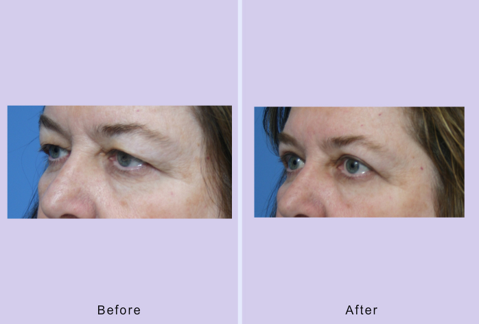 Before and After Image: blepharoplasty – case 13 - left-front-oblique