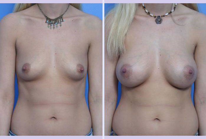 Before and After Image: breast augmentation – Case 1 - front