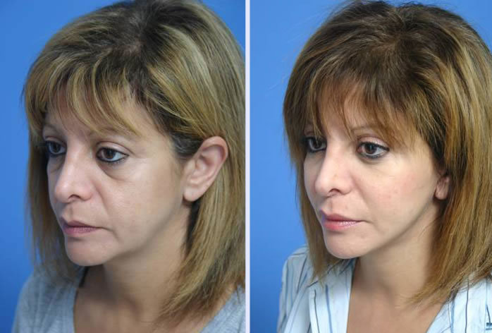 Before and After Image: 3-d volumetric facelift – case 3 - left-front-oblique