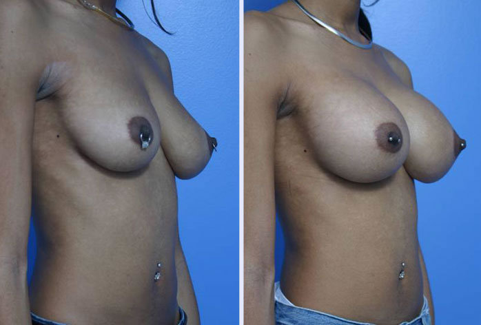Before and After Image: breast augmentation – Case 26 - right-front-oblique