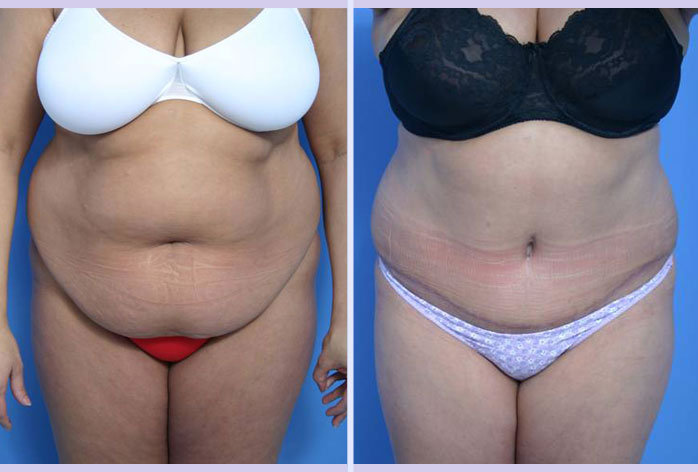 Before and After Image: abdominoplasty – tummy tuck – Case 25 - front